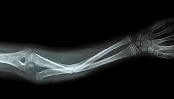 Personal Injury Thumbnail